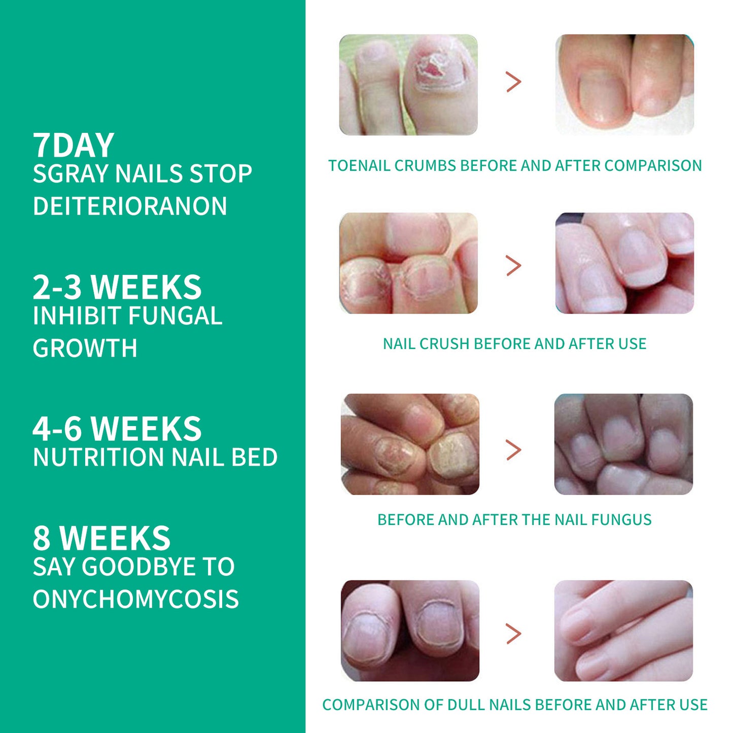Repair Raw Nail Rotten Toenail Bad Gentle Get Rid Of Gray