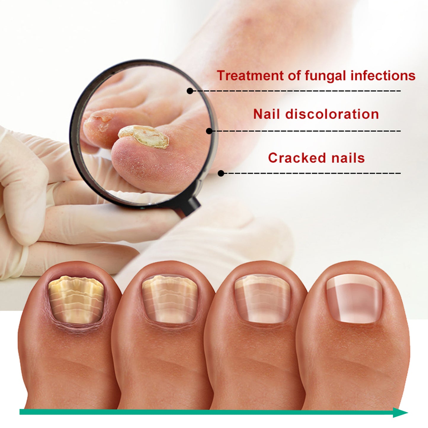 Repair Raw Nail Rotten Toenail Bad Gentle Get Rid Of Gray