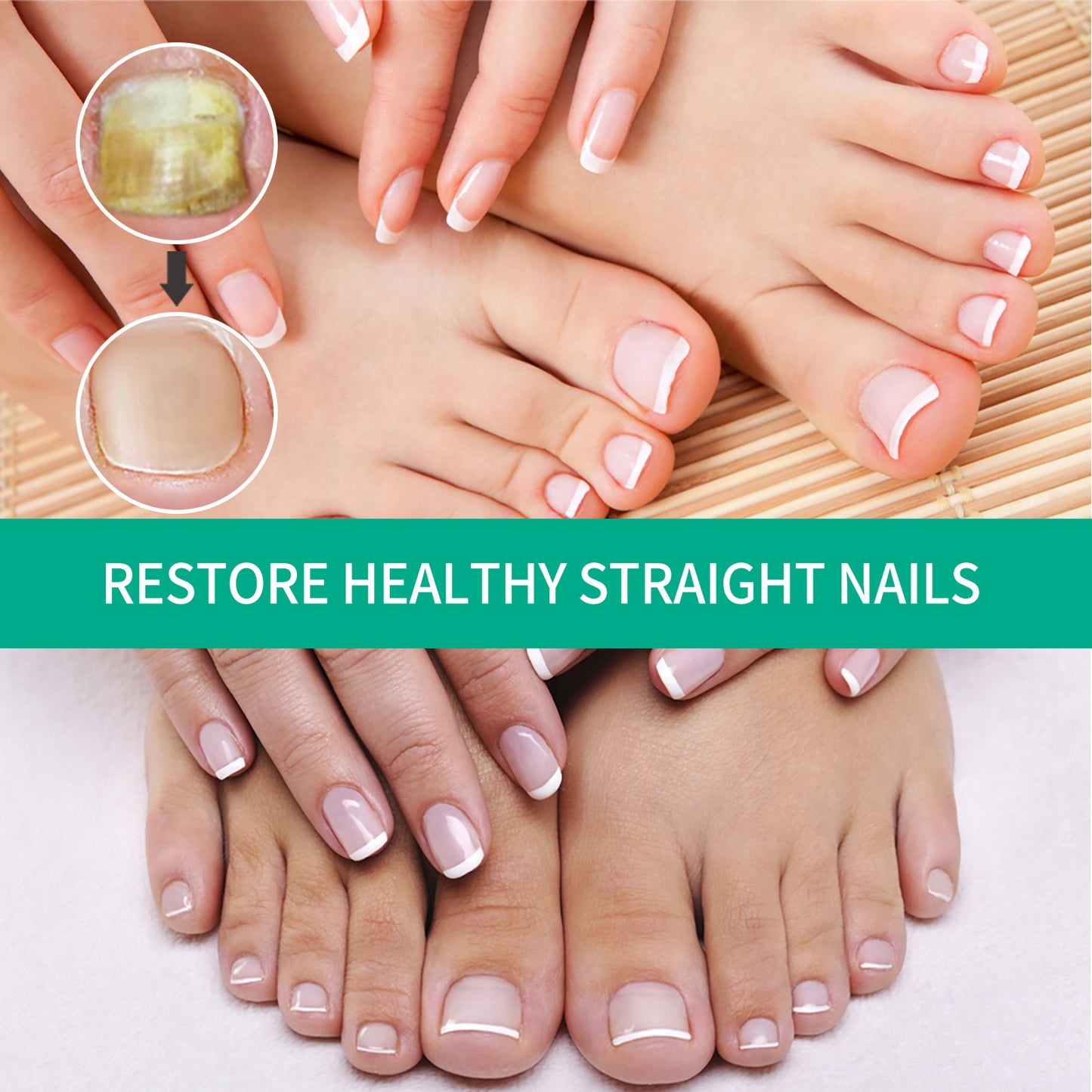 Repair Raw Nail Rotten Toenail Bad Gentle Get Rid Of Gray